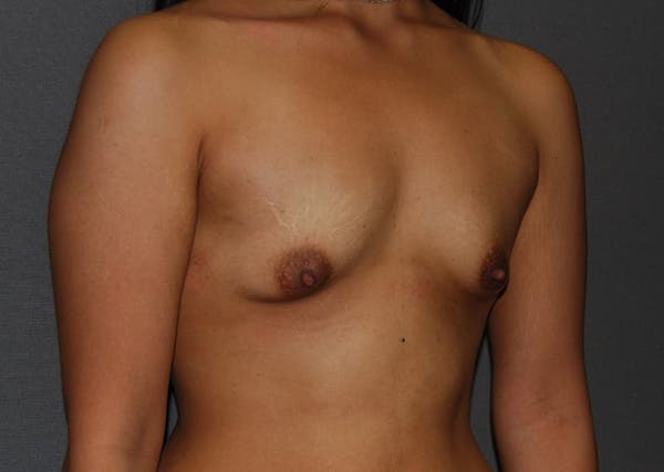 Breast Augmentation Before & After Gallery - Patient 94080427 - Image 7