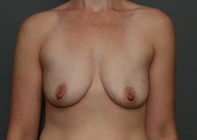 Breast Augmentation Before & After Gallery - Patient 94080428 - Image 1
