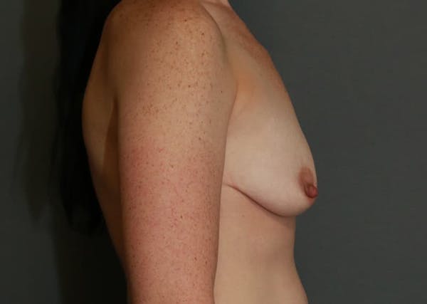 Breast Augmentation Before & After Gallery - Patient 94080428 - Image 5