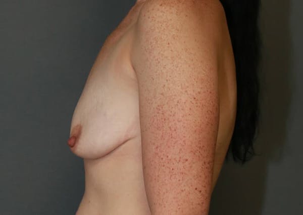 Breast Augmentation Before & After Gallery - Patient 94080428 - Image 9
