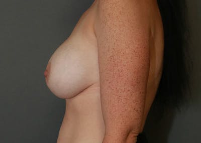Breast Augmentation Before & After Gallery - Patient 94080428 - Image 10