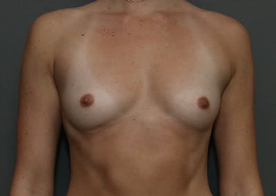 Breast Augmentation Before & After Gallery - Patient 94080429 - Image 1