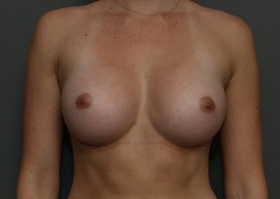Breast Augmentation Before & After Gallery - Patient 94080429 - Image 2