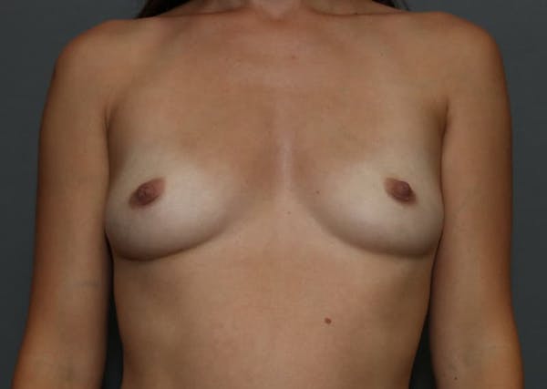 Breast Augmentation Before & After Gallery - Patient 94080432 - Image 1