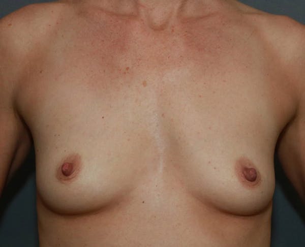 Breast Augmentation Before & After Gallery - Patient 98286890 - Image 1