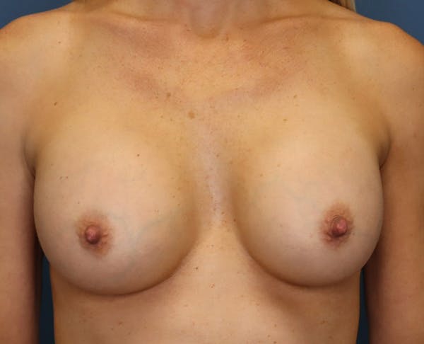 Breast Augmentation Before & After Gallery - Patient 98286890 - Image 2