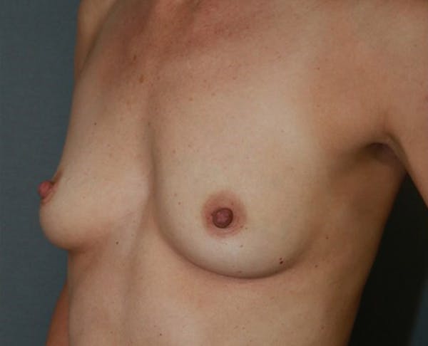 Breast Augmentation Before & After Gallery - Patient 98286890 - Image 3