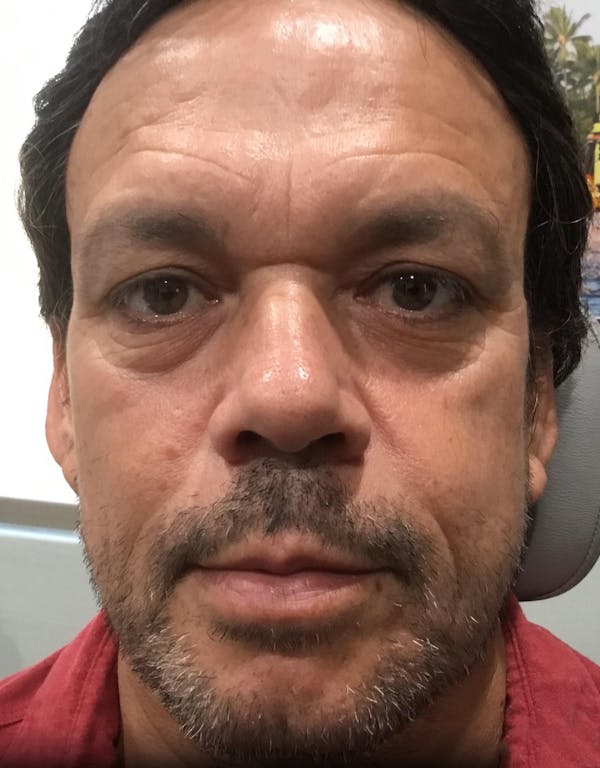 Dermal fillers in Irvine