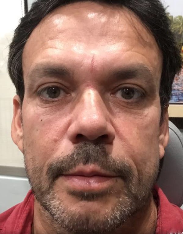 Dermal fillers in Irvine