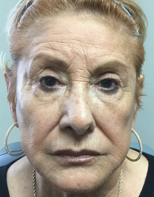 Face Fillers Before & After Gallery - Patient 99750487 - Image 1