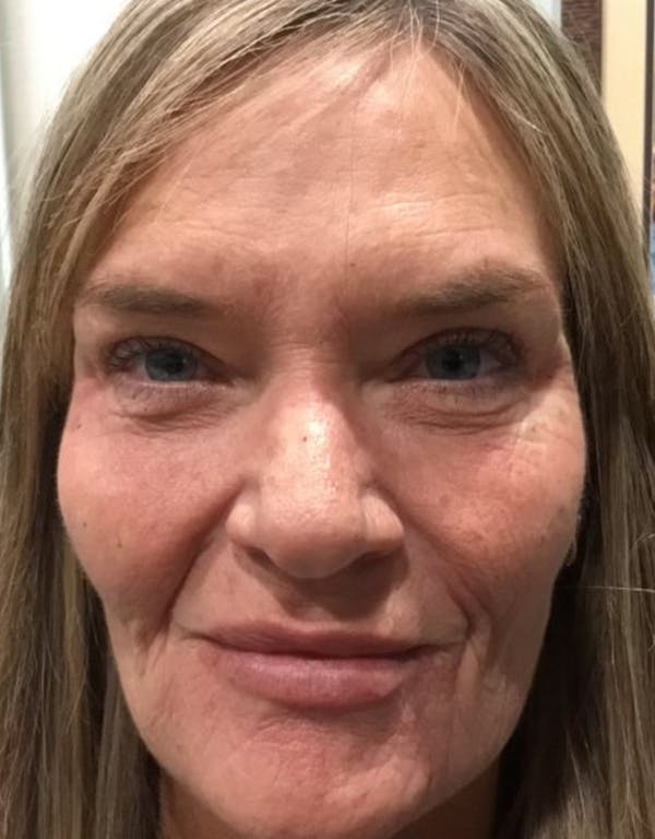 Dermal fillers in Irvine, 