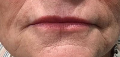 Lip Filler Before & After Gallery - Patient 99750492 - Image 2