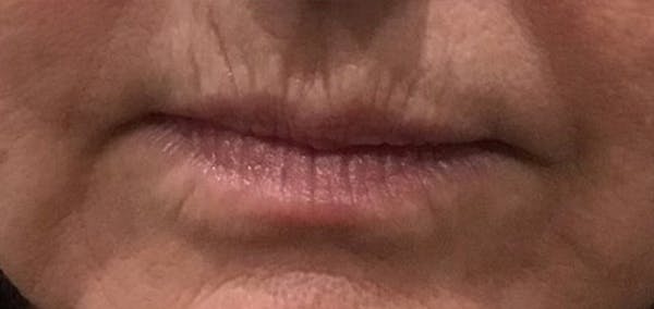 Lip Filler Before & After Gallery - Patient 190615553 - Image 1