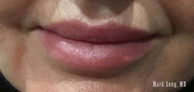 Lip Filler Before & After Gallery - Patient 190615553 - Image 2
