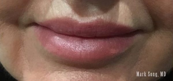 Lip Filler Before & After Gallery - Patient 190615553 - Image 2