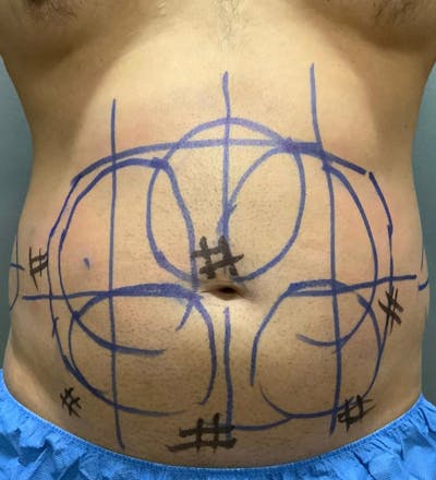 Microcannula Liposuction Before & After Gallery - Patient 99750523 - Image 1