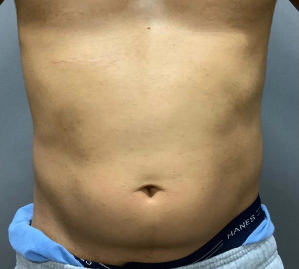 Microcannula Liposuction Before & After Gallery - Patient 99750524 - Image 1