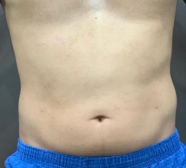 Microcannula Liposuction Before & After Gallery - Patient 99750524 - Image 2