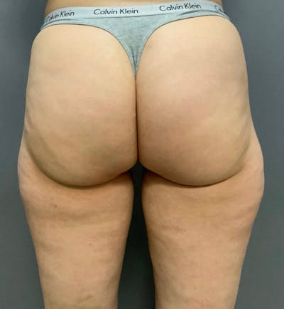 Microcannula Liposuction Before & After Gallery - Patient 99750525 - Image 1