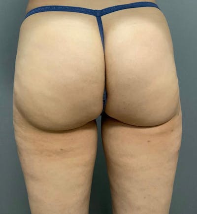 Microcannula Liposuction Before & After Gallery - Patient 99750525 - Image 2