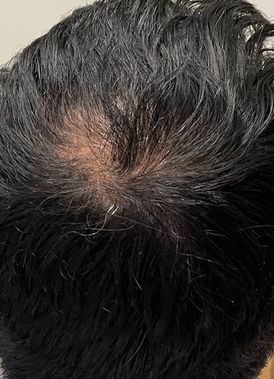 Keravive Scalp Treatment Before & After Gallery - Patient 107320952 - Image 2