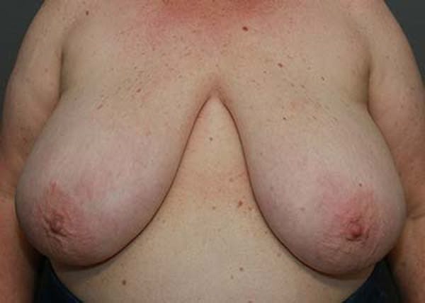 Breast Reduction Before & After Gallery - Patient 121669553 - Image 1