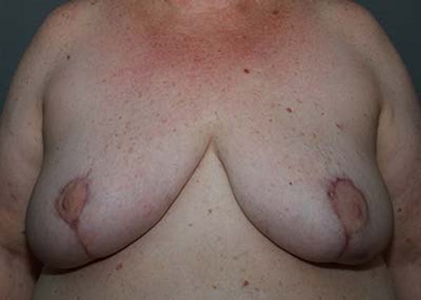 Breast Reduction Before & After Gallery - Patient 121669553 - Image 2