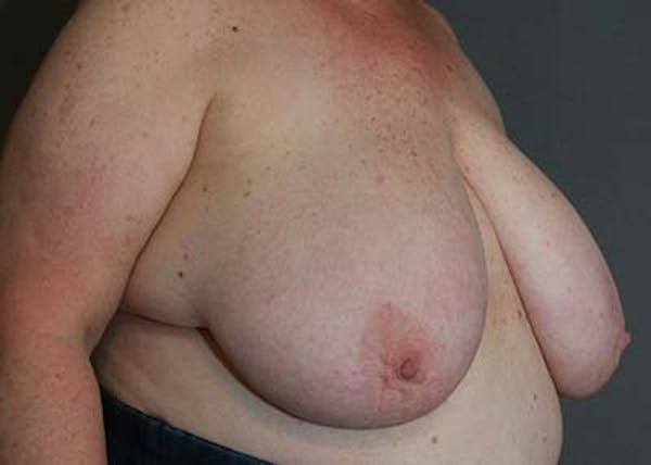 Breast Reduction Before & After Gallery - Patient 121669553 - Image 3