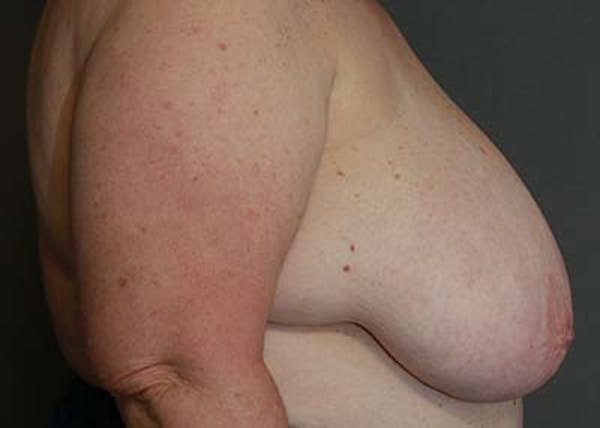 Breast Reduction Before & After Gallery - Patient 121669553 - Image 5