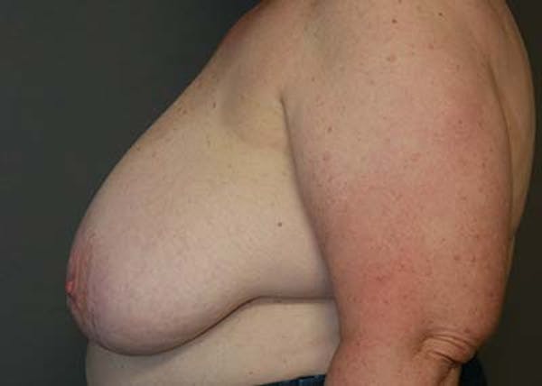 Breast Reduction Before & After Gallery - Patient 121669553 - Image 7