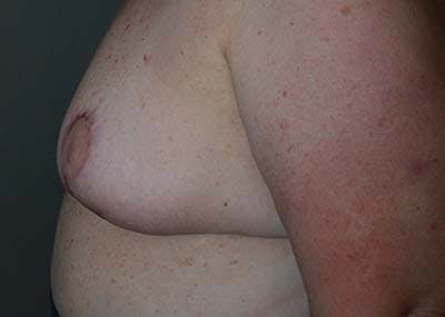 Breast Reduction Before & After Gallery - Patient 121669553 - Image 8