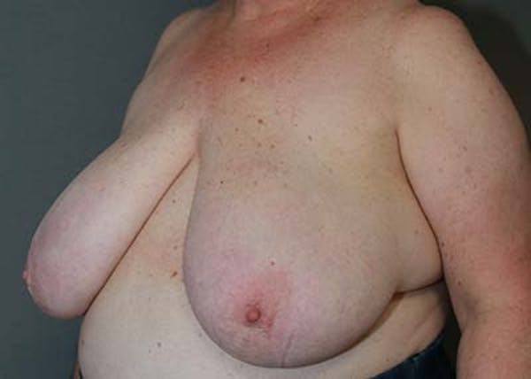 Breast Reduction Before & After Gallery - Patient 121669553 - Image 9
