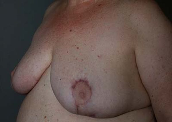 Breast Reduction Before & After Gallery - Patient 121669553 - Image 10