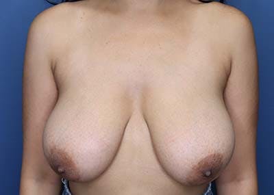 Breast Reduction Before & After Gallery - Patient 121669871 - Image 1