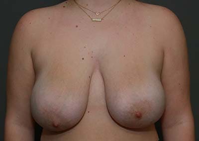 Breast Reduction Before & After Gallery - Patient 121669931 - Image 1