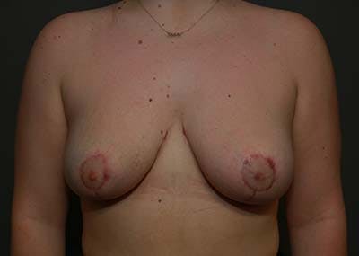 Breast Reduction Before & After Gallery - Patient 121669931 - Image 2