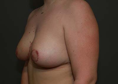 Breast Reduction Before & After Gallery - Patient 121669931 - Image 4