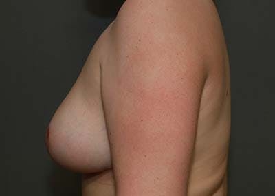 Breast Reduction Before & After Gallery - Patient 121669931 - Image 6