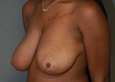 Breast Reduction Before & After Gallery - Patient 121669932 - Image 1