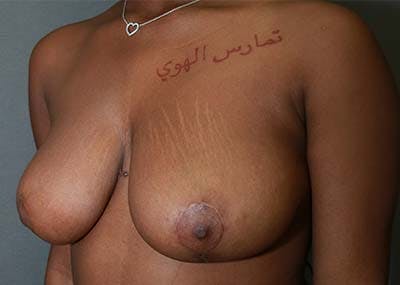 Breast Reduction Before & After Gallery - Patient 121669932 - Image 2
