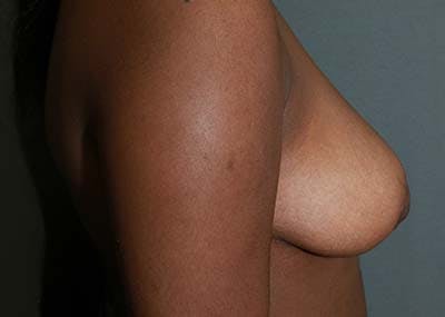 Breast Reduction Before & After Gallery - Patient 121669932 - Image 4