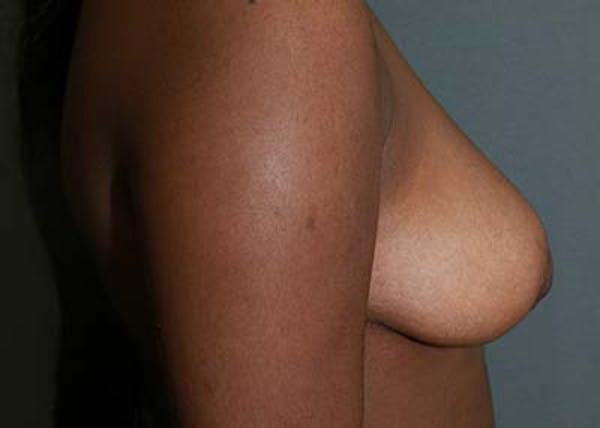 Breast Reduction Before & After Gallery - Patient 121669932 - Image 4