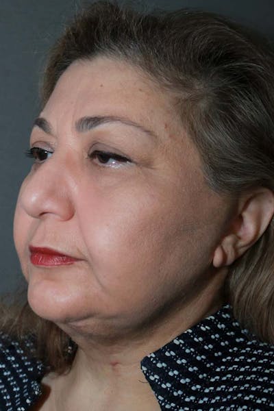 Facelift Before & After Gallery - Patient 121724324 - Image 2