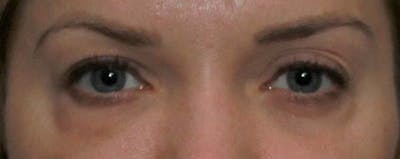 Lower Blepharoplasty Gallery - Patient 121724332 - Image 1