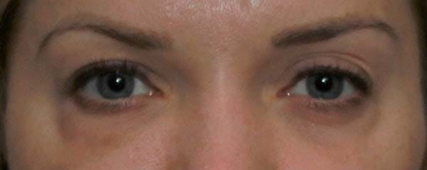 Lower Blepharoplasty Before & After Gallery - Patient 121724332 - Image 1
