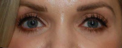 Lower Blepharoplasty Before & After Gallery - Patient 121724332 - Image 2