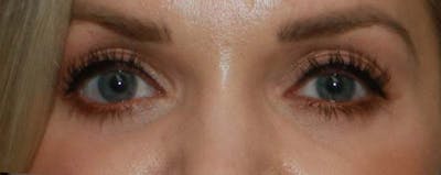 Lower Blepharoplasty Gallery - Patient 121724332 - Image 2