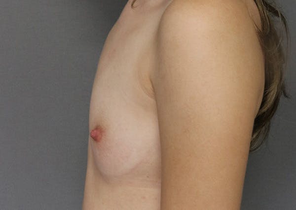 Breast Augmentation Before & After Gallery - Patient 123044975 - Image 9