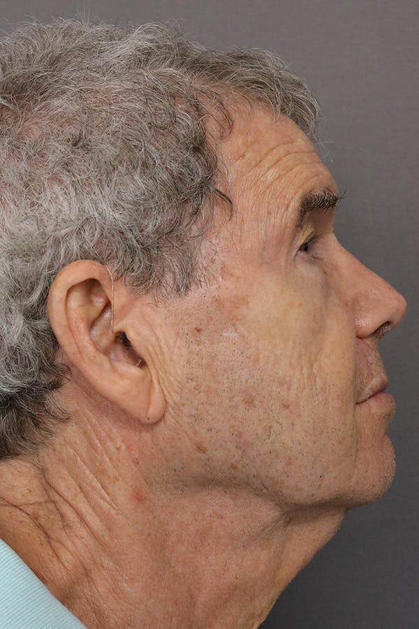Neck Lift Before & After Gallery - Patient 123174888 - Image 1