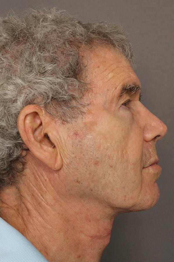 Neck Lift Before & After Gallery - Patient 123174888 - Image 2